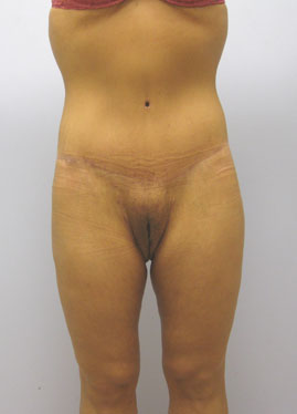 Tummy Tuck Before & After Image