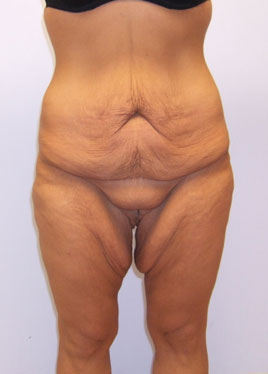 Tummy Tuck Before & After Image