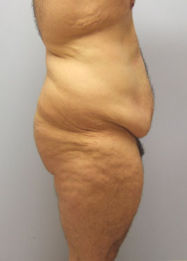 Tummy Tuck Before & After Image