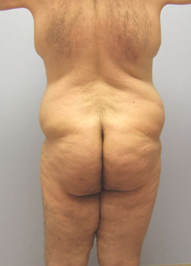 Tummy Tuck Before & After Image