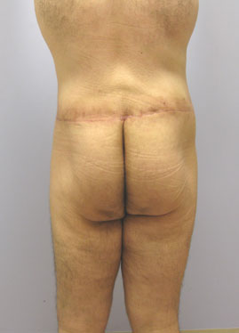 Tummy Tuck Before & After Image