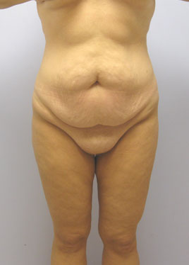 Tummy Tuck Before & After Image