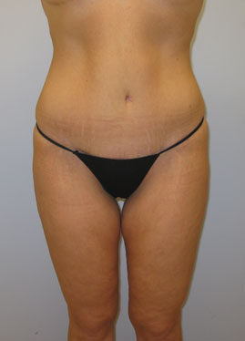 Tummy Tuck Before & After Image