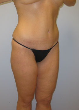 Tummy Tuck Before & After Image