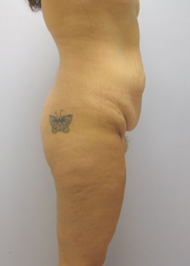 Tummy Tuck Before & After Image