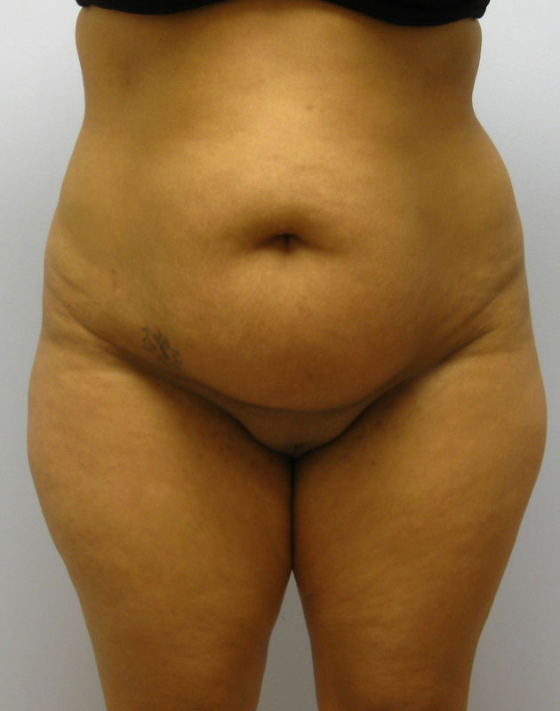 Tummy Tuck Before & After Image