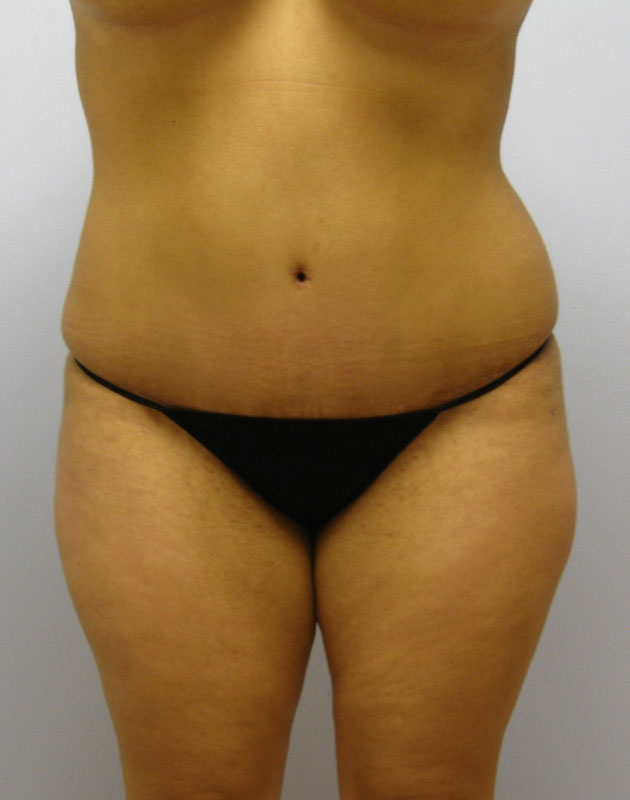 Tummy Tuck Before & After Image