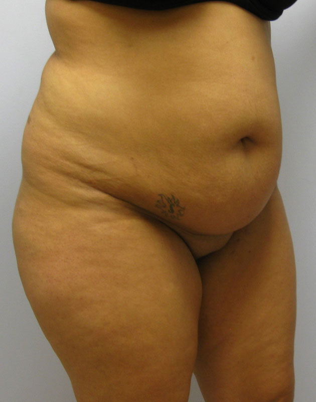 Tummy Tuck Before & After Image