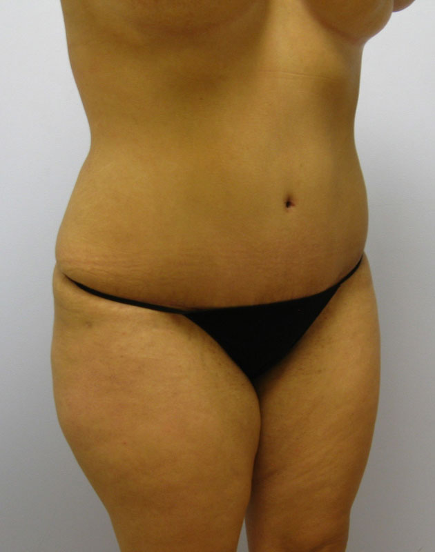 Tummy Tuck Before & After Image