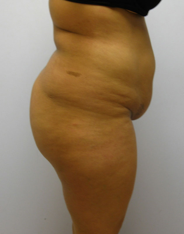 Tummy Tuck Before & After Image