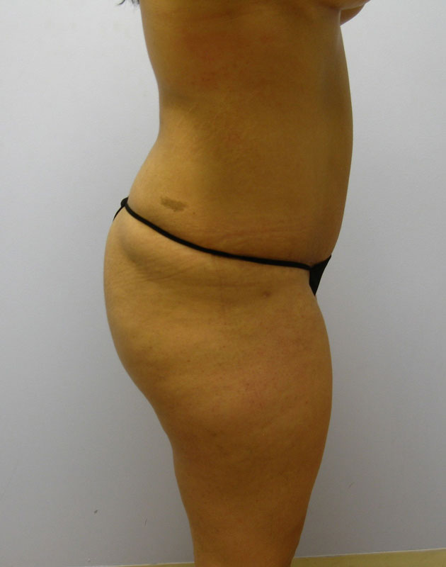 Tummy Tuck Before & After Image