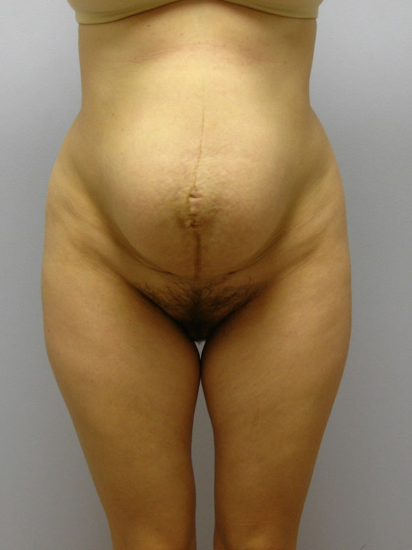 Tummy Tuck Before & After Image