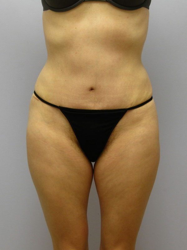 Tummy Tuck Before & After Image