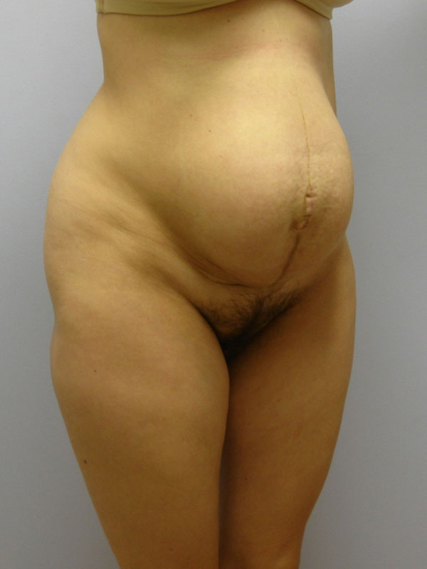 Tummy Tuck Before & After Image