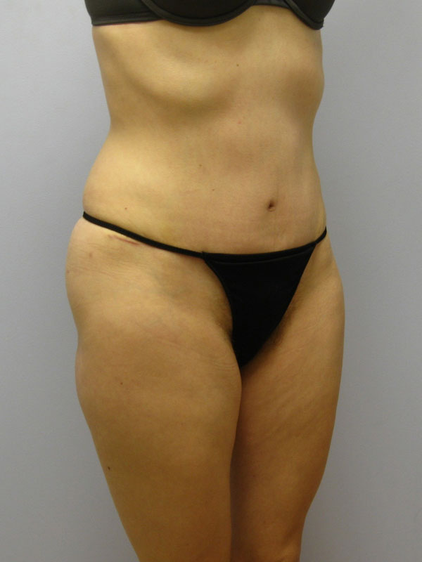 Tummy Tuck Before & After Image