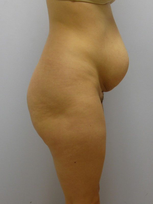 Tummy Tuck Before & After Image