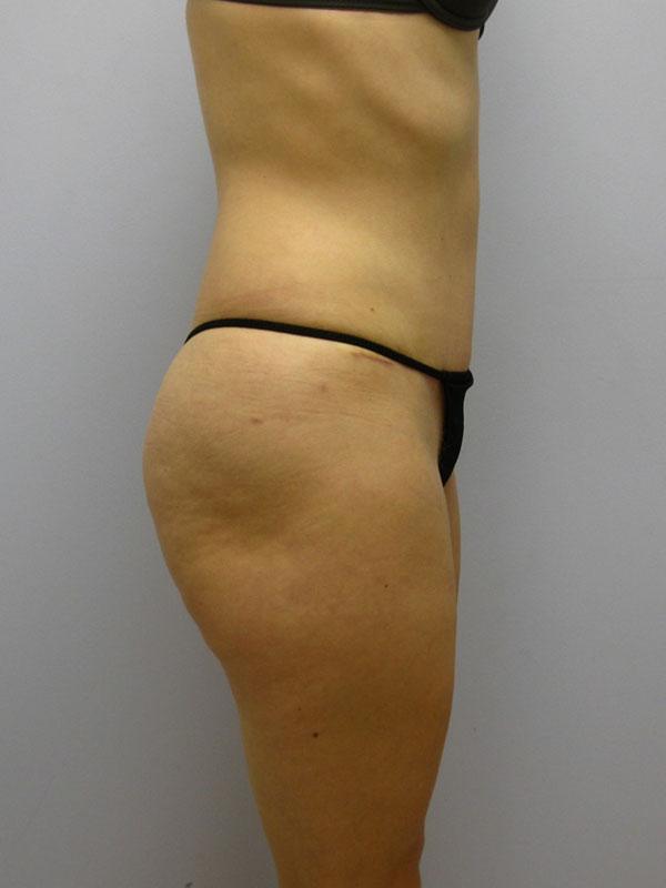 Tummy Tuck Before & After Image