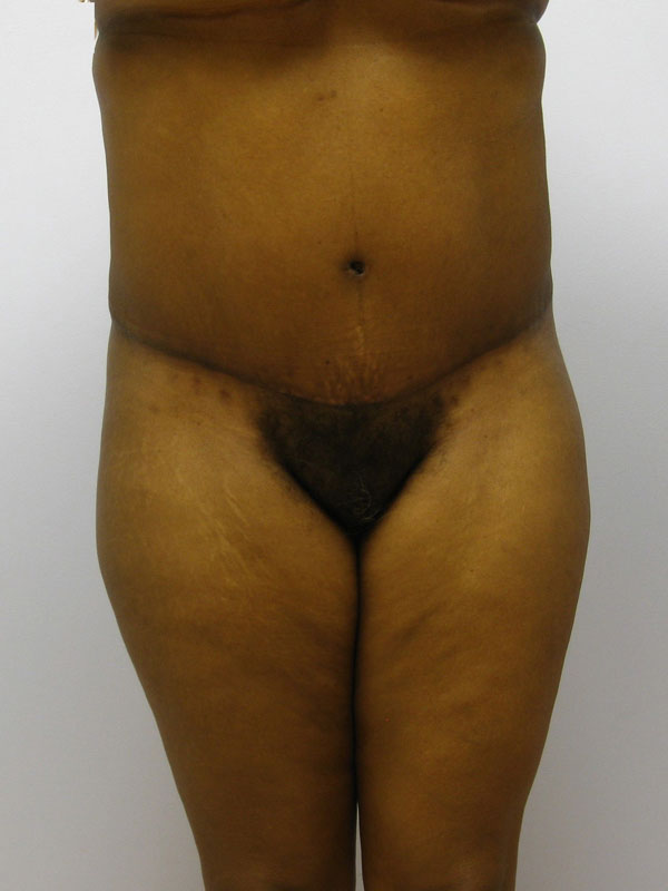 Tummy Tuck Before & After Image