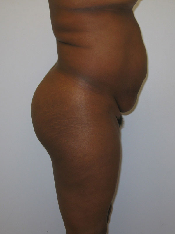 Tummy Tuck Before & After Image