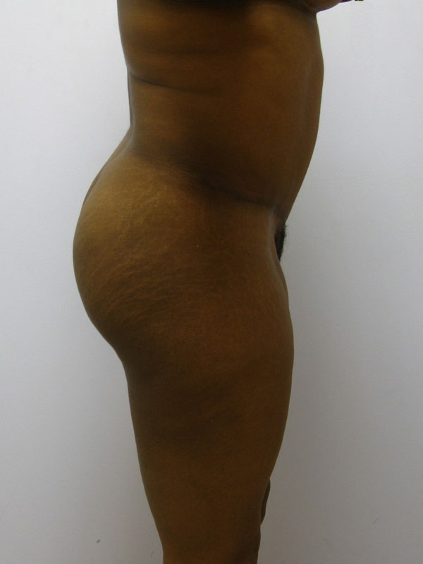 Tummy Tuck Before & After Image