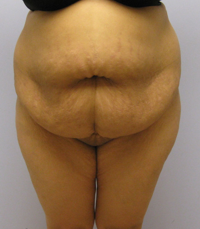 Tummy Tuck Before & After Image