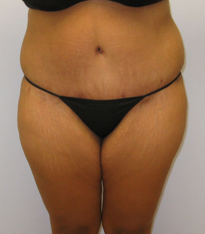 Tummy Tuck Before & After Image