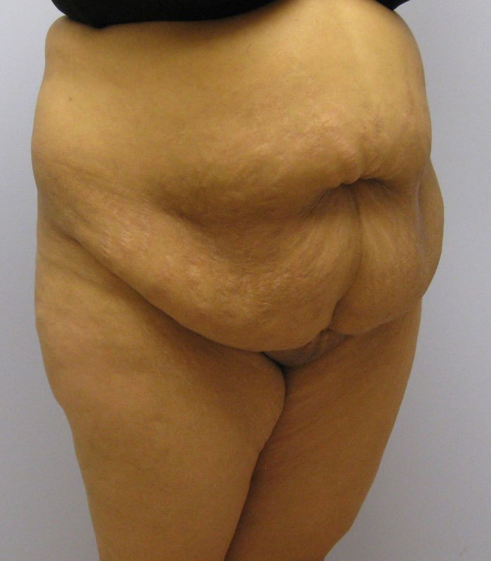 Tummy Tuck Before & After Image