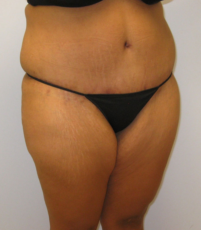 Tummy Tuck Before & After Image