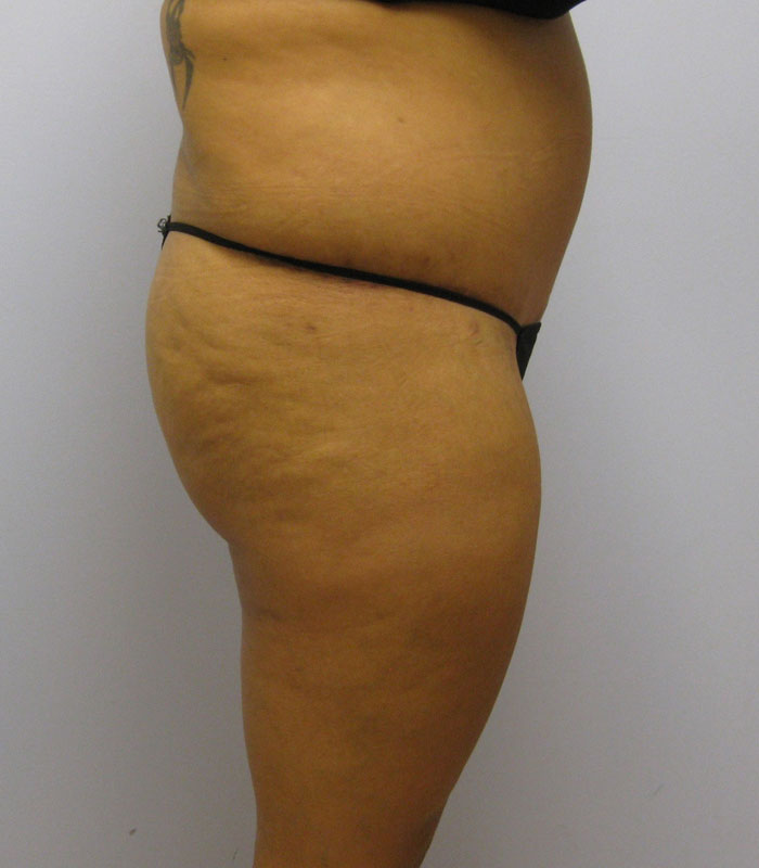 Tummy Tuck Before & After Image