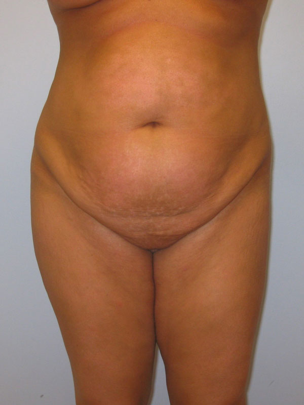 Tummy Tuck Before & After Image