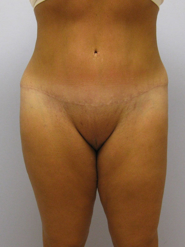 Tummy Tuck Before & After Image