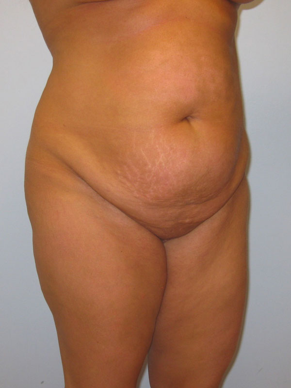 Tummy Tuck Before & After Image