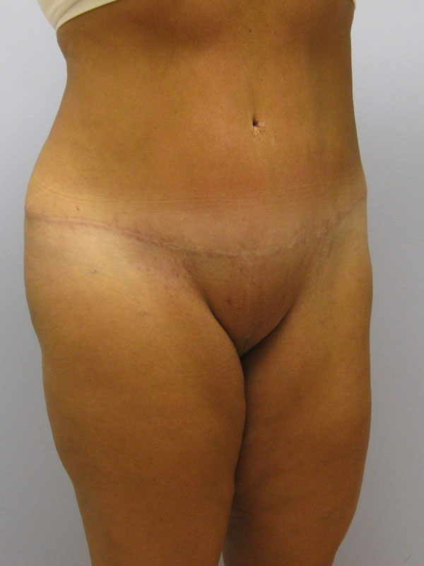 Tummy Tuck Before & After Image