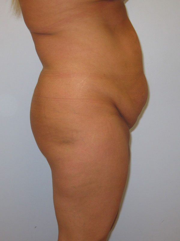 Tummy Tuck Before & After Image