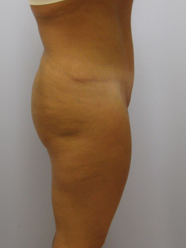 Tummy Tuck Before & After Image