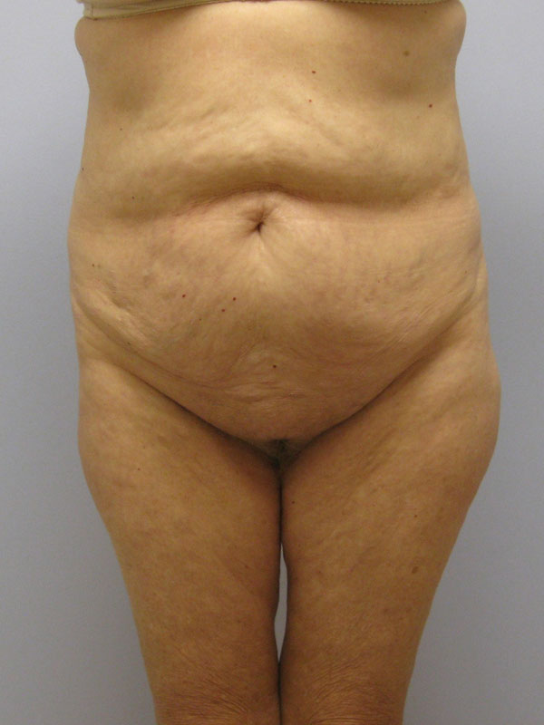 Tummy Tuck Before & After Image