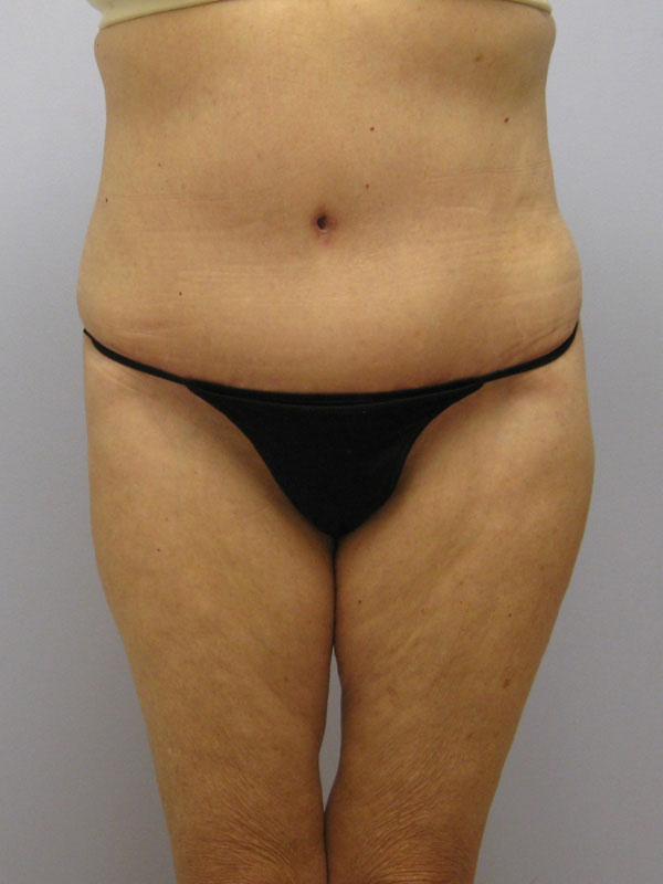 Tummy Tuck Before & After Image