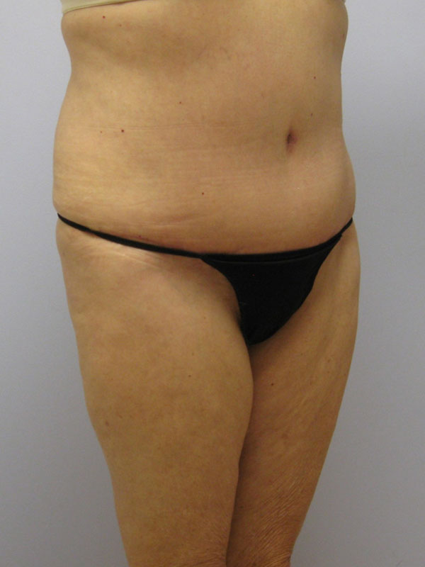 Tummy Tuck Before & After Image