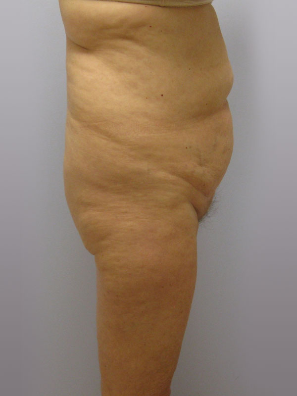 Tummy Tuck Before & After Image