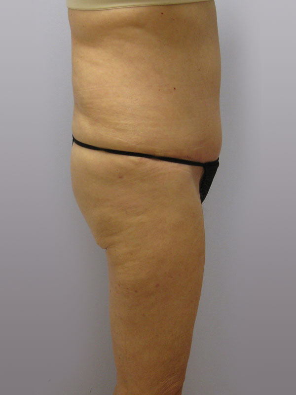 Tummy Tuck Before & After Image