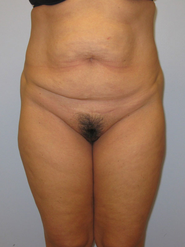 Tummy Tuck Before & After Image