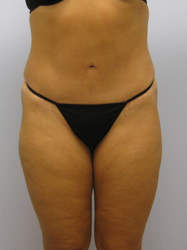 Tummy Tuck Before & After Image