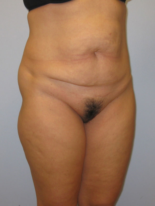 Tummy Tuck Before & After Image