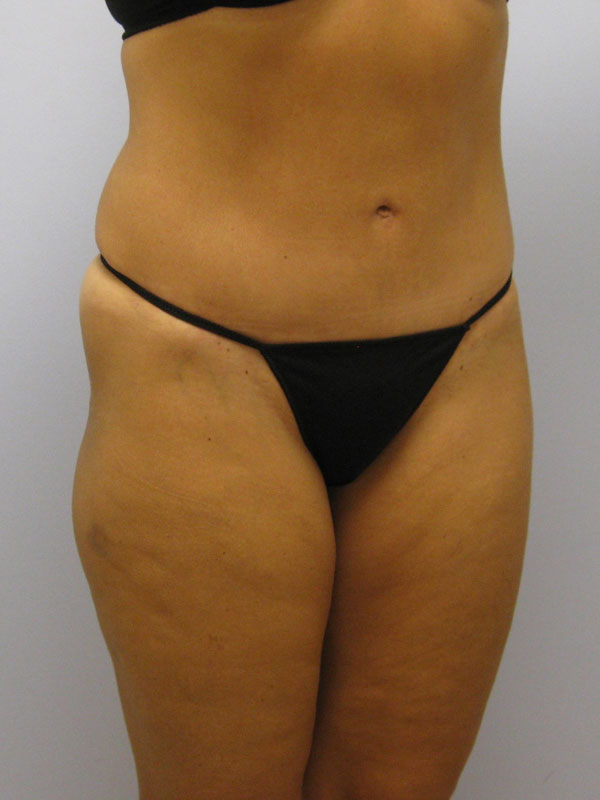 Tummy Tuck Before & After Image