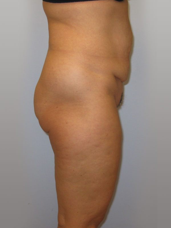 Tummy Tuck Before & After Image