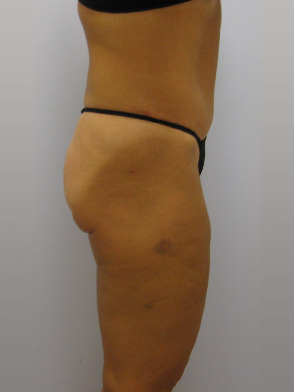 Tummy Tuck Before & After Image