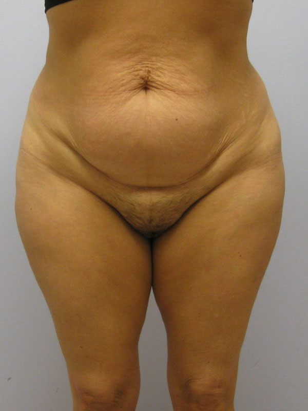 Tummy Tuck Before & After Image