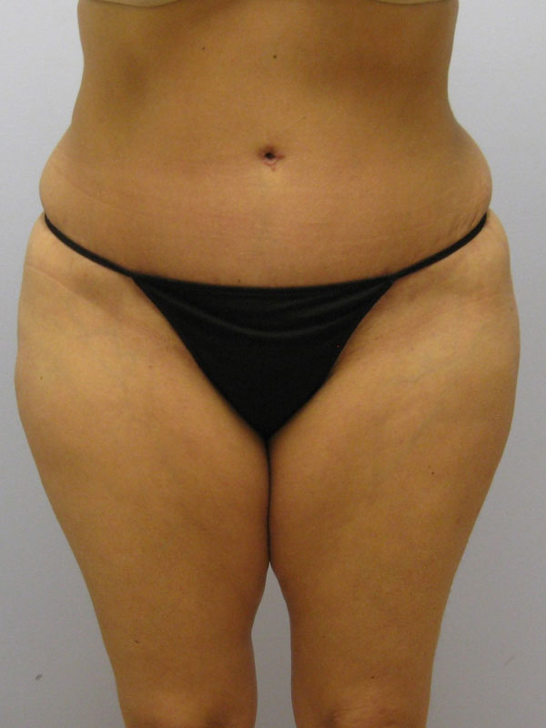 Tummy Tuck Before & After Image