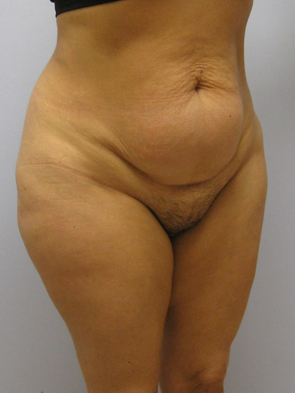 Tummy Tuck Before & After Image