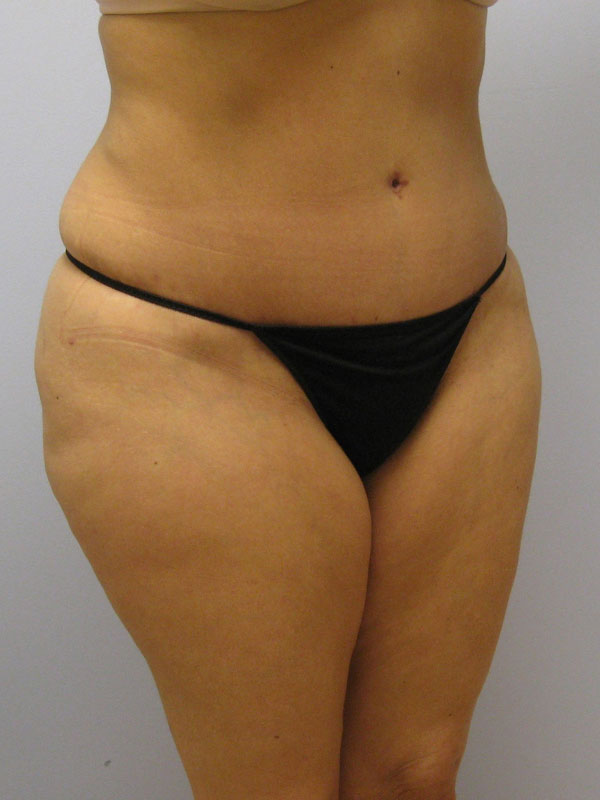 Tummy Tuck Before & After Image